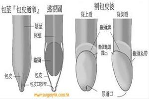 呼市割了包皮包皮往上翻(做完包茎手术皮往外翻怎么办)