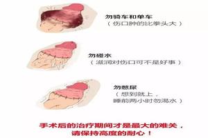 呼和浩特包皮割后会(割了皮包多久可以同房)