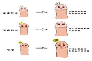 呼市14岁阴茎包皮翻不开(儿童包茎翻不开)