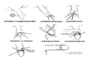 呼和浩特割包皮选择环切还是激光(呼和浩特男科哪个比较好)
