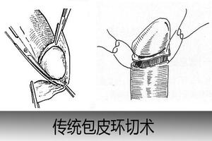 呼市包皮环切手术前后注意事项(包皮环切准备)