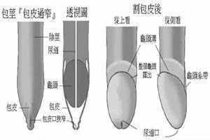 呼和浩特包皮嵌顿要做手术吗(包皮嵌顿要多少钱)