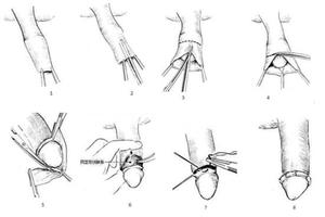 呼市割包皮前应注意哪些(割包皮前提条件)