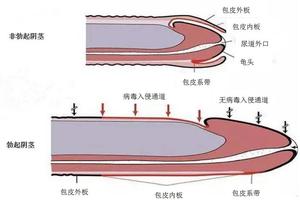 呼市假性包皮过长割了包皮后的后果(假性包茎割了后悔)